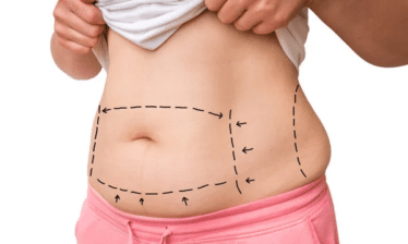 Areas for liposuction