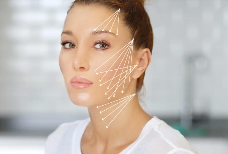 thread lift treatment on woman's face