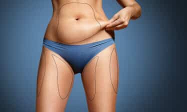 woman prepares for liposuction