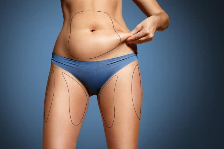 woman prepares for liposuction