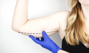 plastic surgeon marking for brachioplasty arm lift